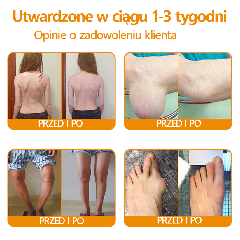 Ropceer™ Krem przeciwbólowy na bazie toksyny botulinowej i jadu pszczelego, wspomagający gojenie kości