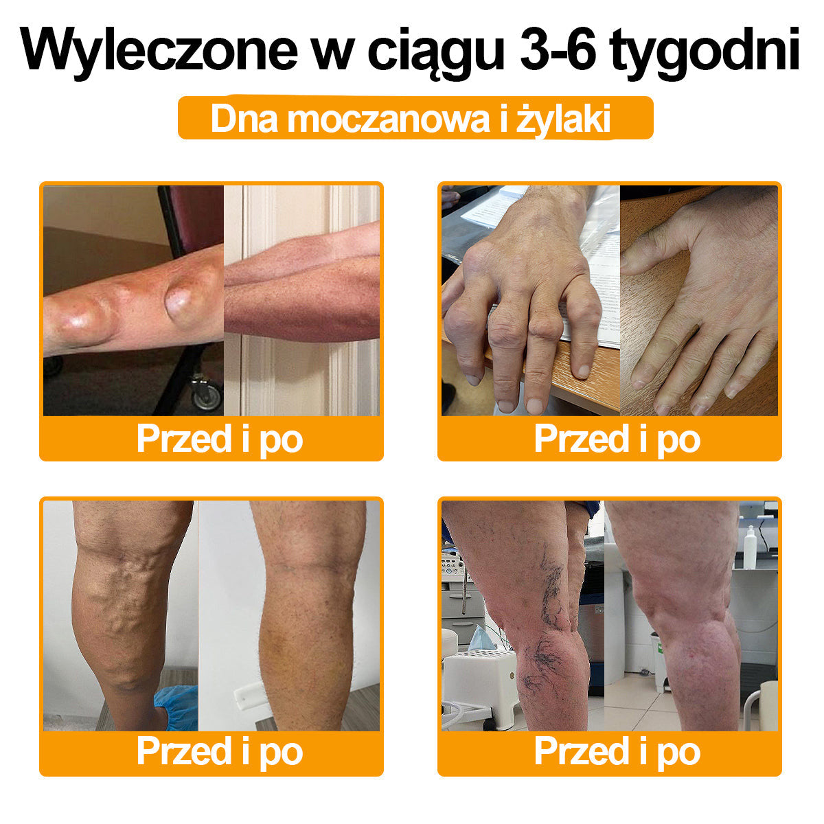 Ropceer™ Krem przeciwbólowy na bazie toksyny botulinowej i jadu pszczelego, wspomagający gojenie kości