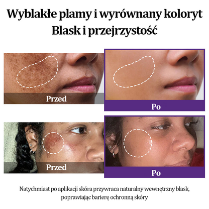 🩷✅ Certyfikacja NFZ| Ropceer® 𝐄𝐏𝐈𝐆𝐋𝐎𝐖 𝐌𝐞𝐥𝐚𝐧𝐄𝐗 Krem do twarzy premium